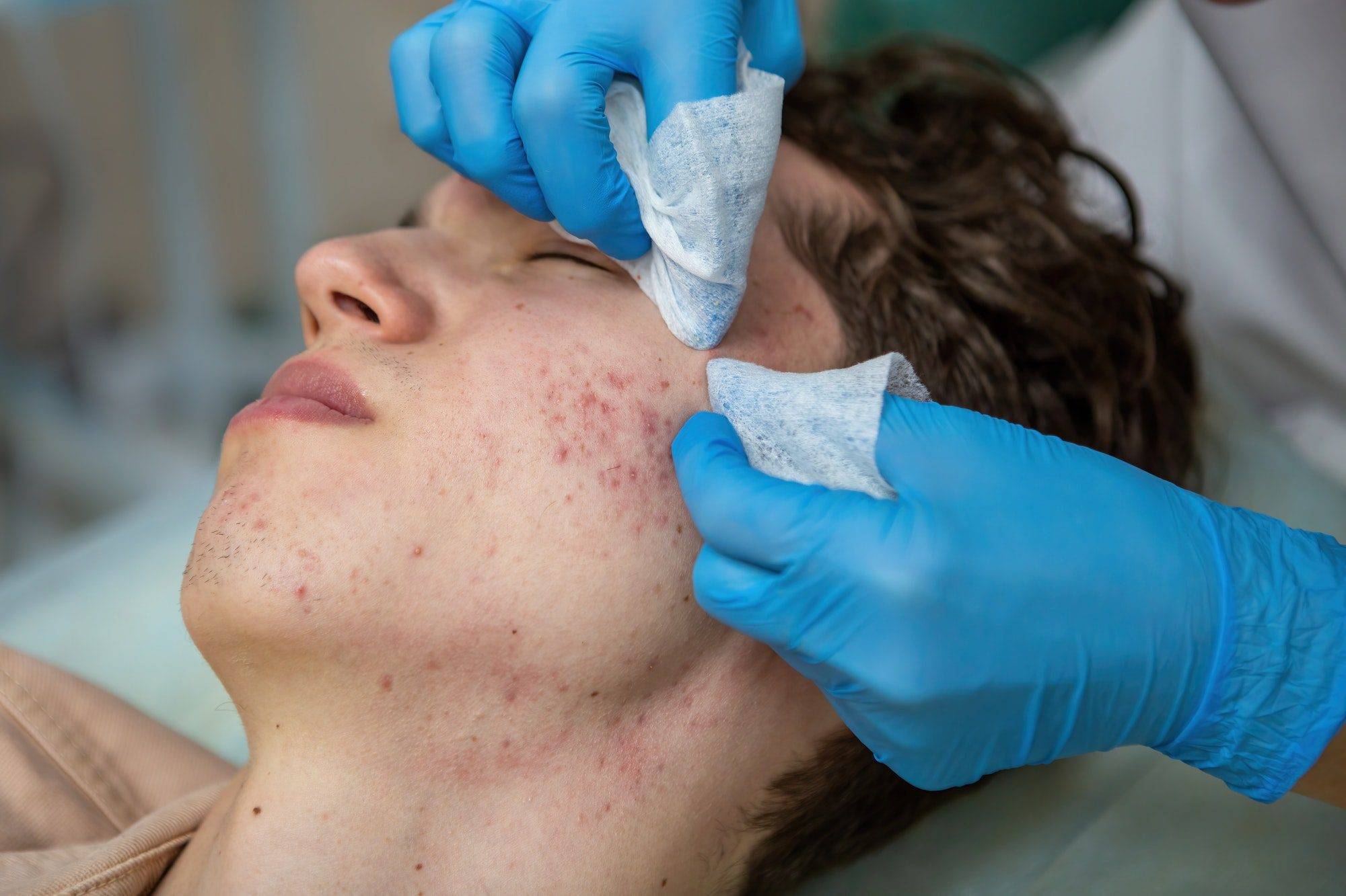Treatment of acne in adolescents. Facial peeling to fight acne on the face