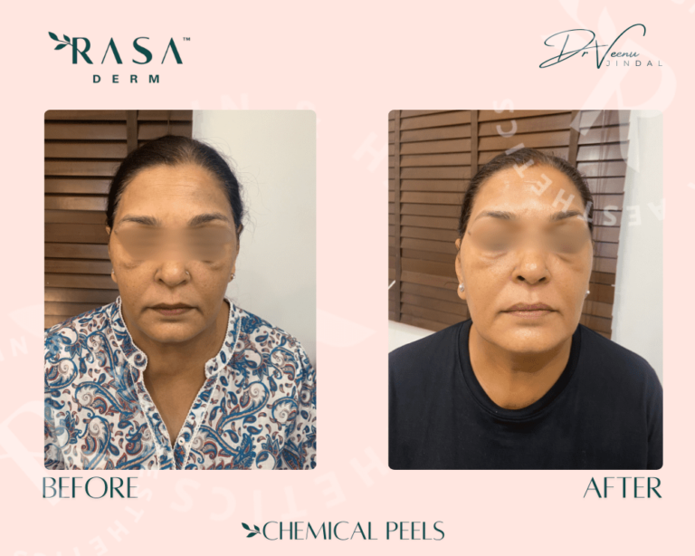 Chemical Peel