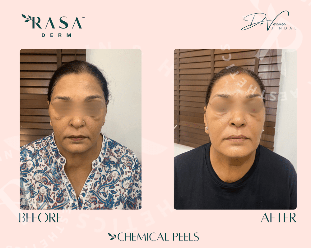 Chemical Peel