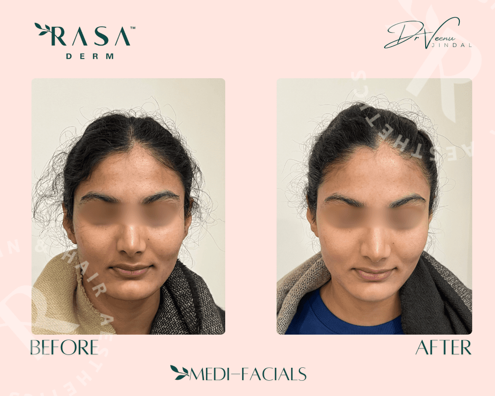 Laser toning Treatment