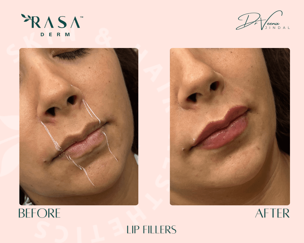 lip fillers in delhi