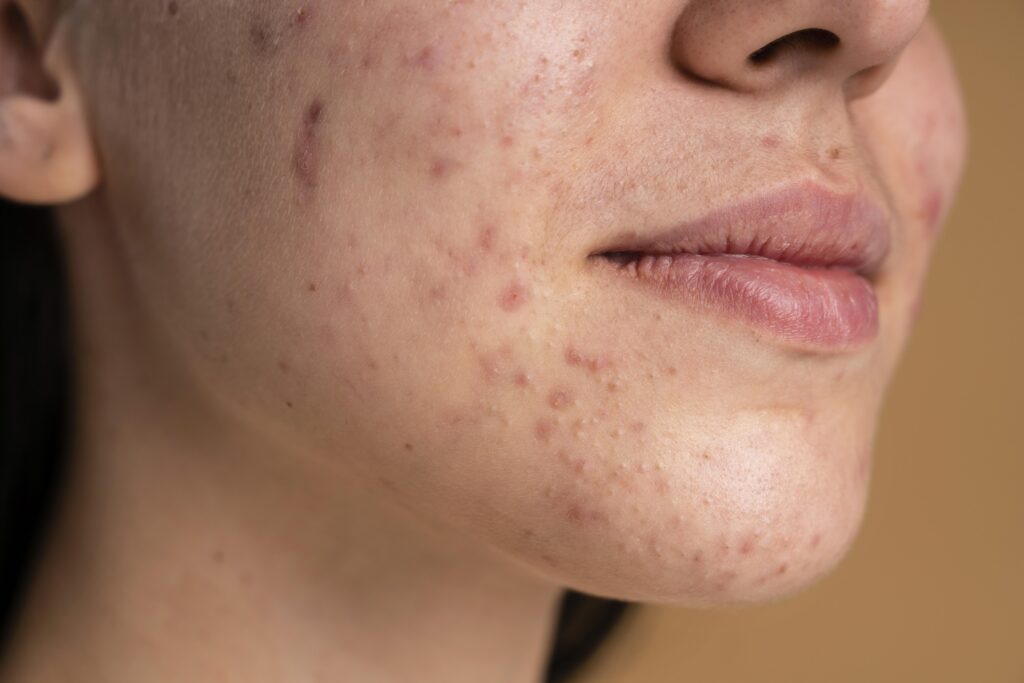 Treat Cheeks with Hyperpigmentation