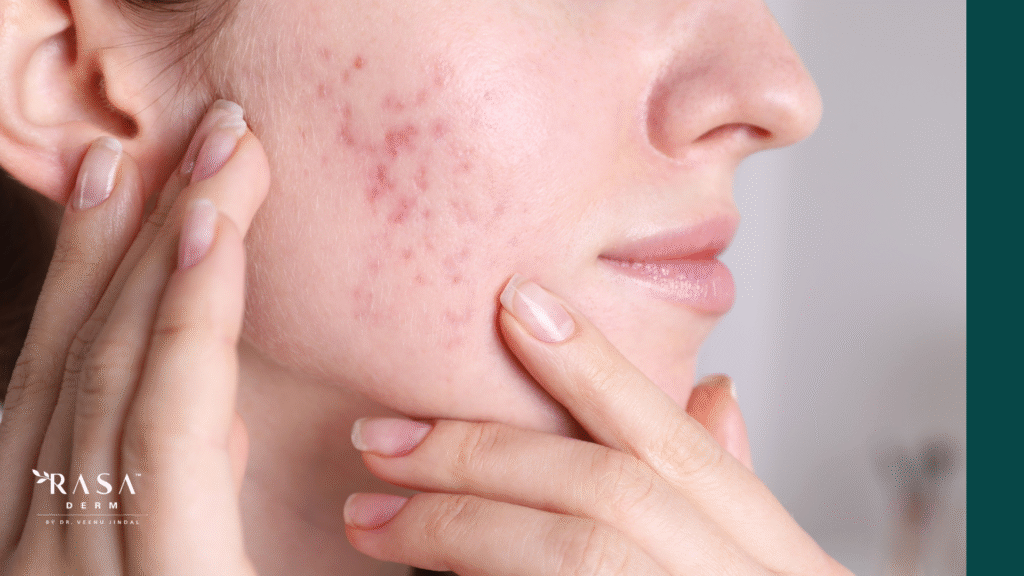 can acne scars go away