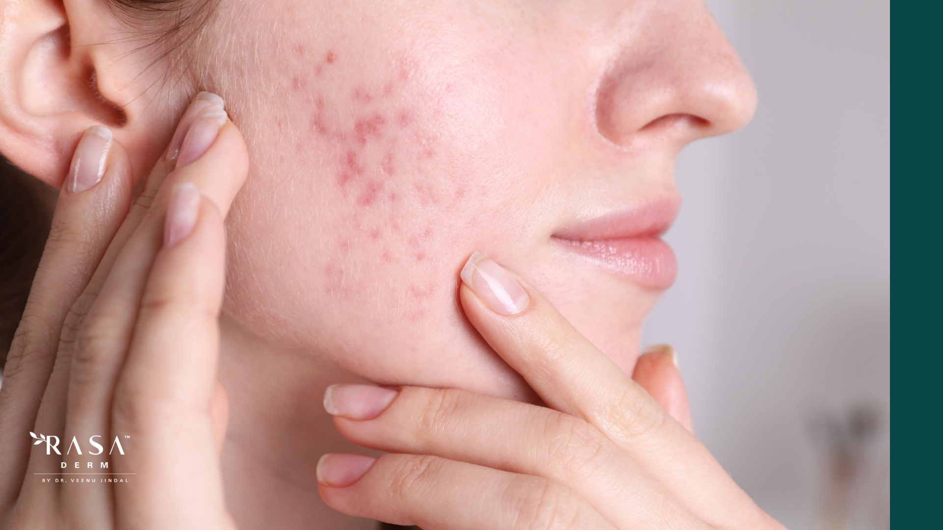 can acne scars go away