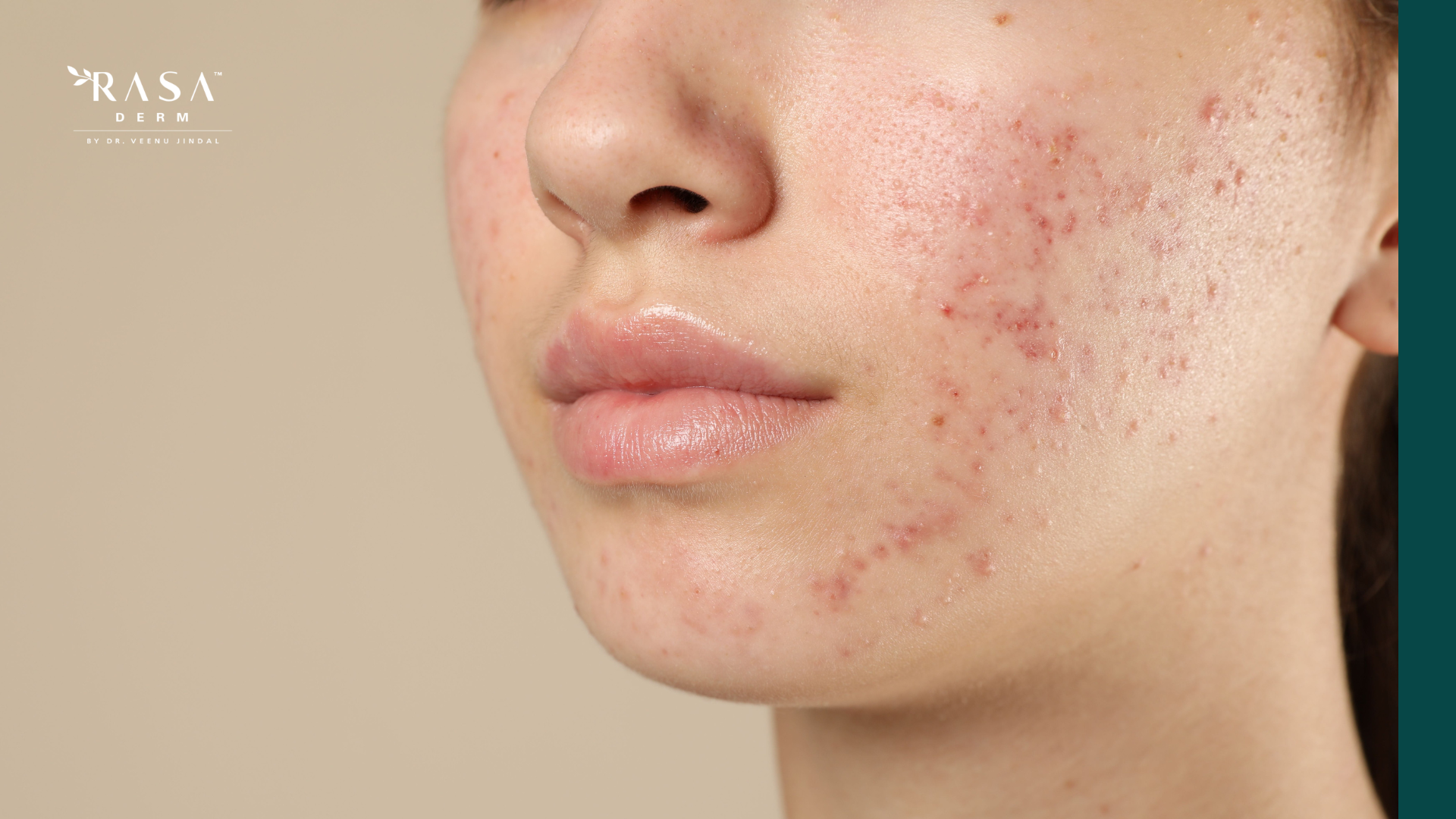 Acne Scars
