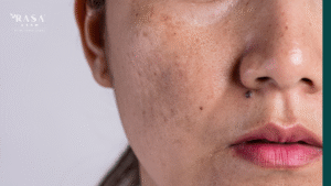 Why Lip Pigmentation Keeps Coming Back: Causes, Prevention, and Long-Term Solutions