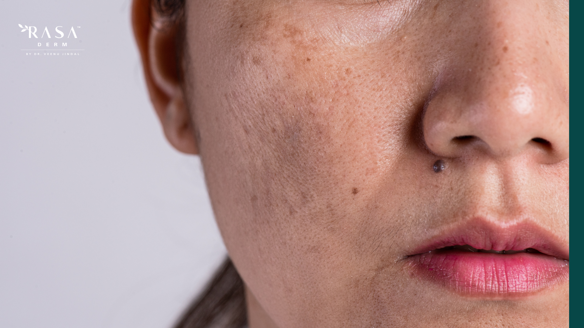 Lip Pigmentation
