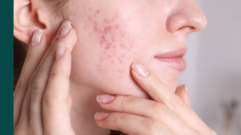 Acne Holes on Face
