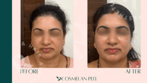 Cosmelan Peel Treatment Price in India: What Affects the Cost?
