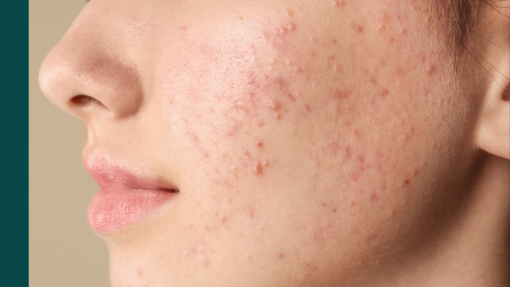 7 Best Treatments for Acne Scars