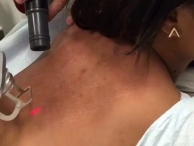 BACK FRACTIONAL BACK FRACTIONAL