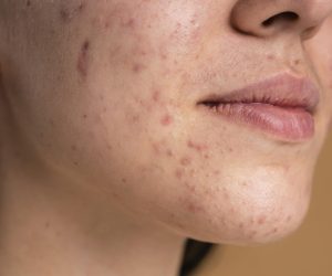 Treat Cheeks with Hyperpigmentation