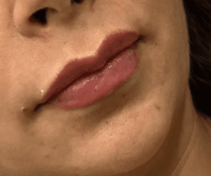 lip filler
