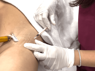 underarm botox